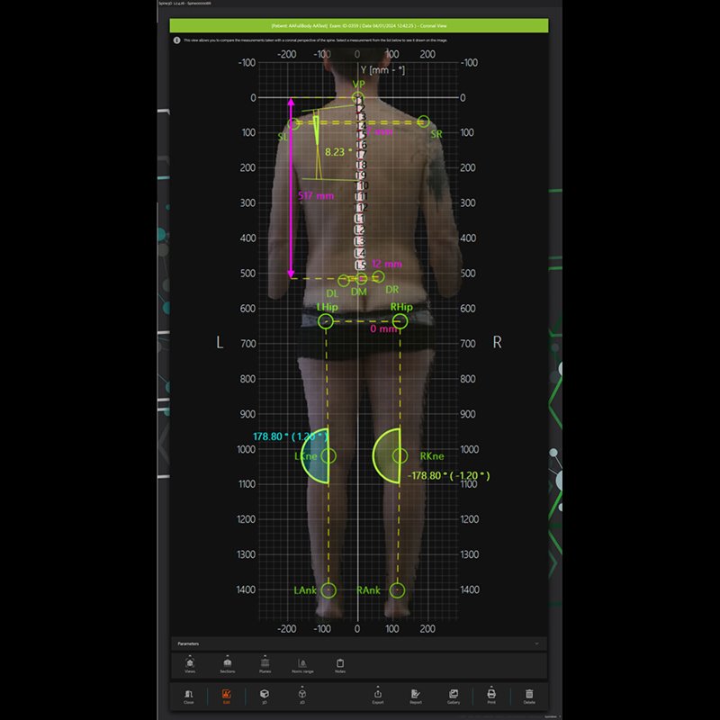 Система трёхмерного сканирования позвоночника Spine3D